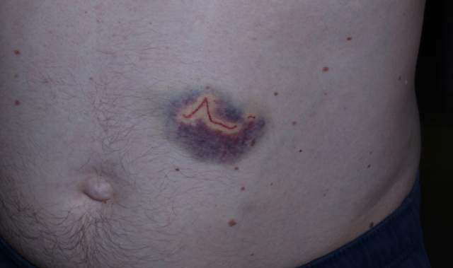 close up of the bruise